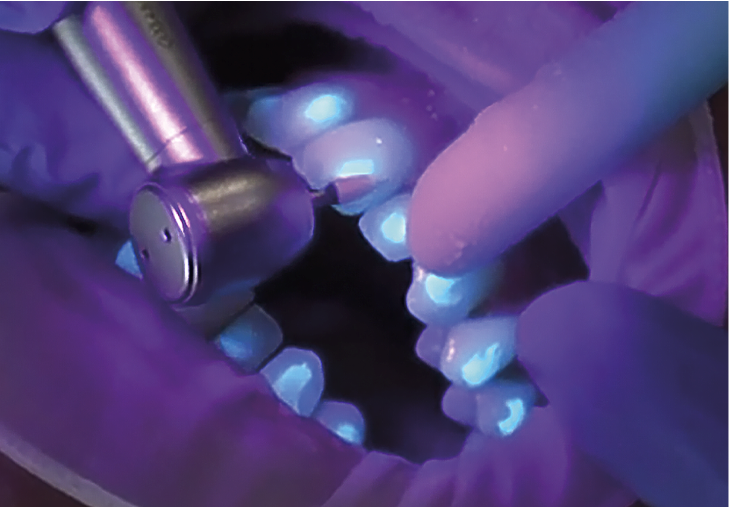 Fluorescent Removal Fluorescent Removal